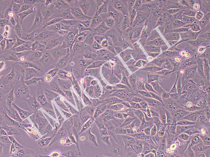 HLF人未分化肝癌(STR鉴定正确)